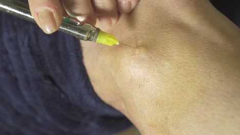 Close-up-of-a-small-medical-needle-injecting-anaesthesia-into-a-patient's-knee-and-exiting-the-skin-after-the-procedure-is-complete