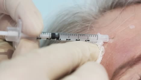 Eine-ältere-Person-Erhält-Eine-Botox-Injektion-In-Die-Stirn,-Um-Falten-Zu-Reduzieren