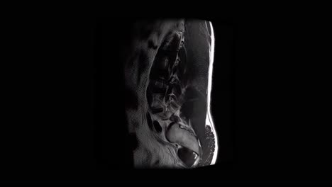 MRI-scan-of-a-male-lumbar-spine-exhibiting-a-lightly-herniated-disc,-scanning-from-side-to-side