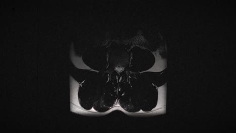 Grungy-and-highly-textured-vintage-MRI-scan-of-male-lumbar-spine-with-a-herniated-disc-due-to-excess-weightlifting-training