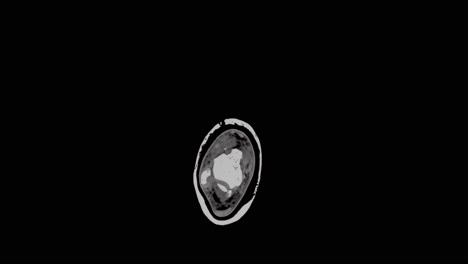 MRI-scan-of-a-foot-showing-multiple-small-fractures,-slowly-scanning-from-top-to-bottom-and-showing-whole-foot