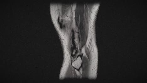 Vintage-textured-MRI-scan-of-an-injured-male-knee,-after-excess-basketball-playing