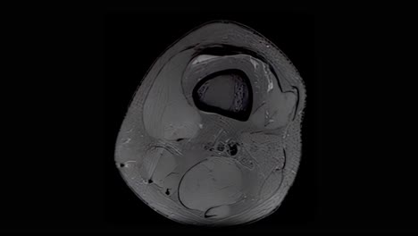 MRI-scan-of-an-injured-male-knee,-scanning-from-top-to-bottom