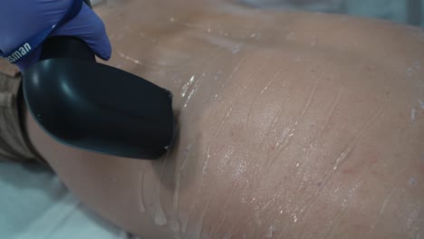Laser-hair-removal-in-action-on-treated-skin---close-up