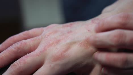 Close-up-of-woman-scratch-hand-with-red-psoriasis-spot-allergic-reaction