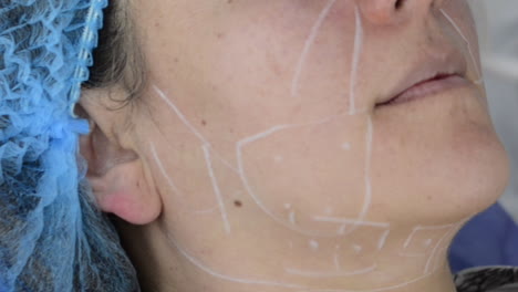 Doctor-trace-marks-with-white-pen-on-patients-face