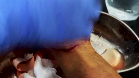 Treatment-of-cleaning-open-wound-treatment