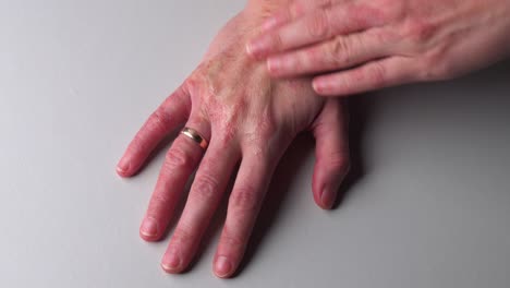 Woman-with-red-dry-and-itchy-skin-apply-hand-cream-on-psoriasis-allergic-spot