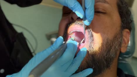 Una-Vista-Cercana-De-Un-Hombre-De-Mediana-Edad-Con-Barba-En-El-Dentista