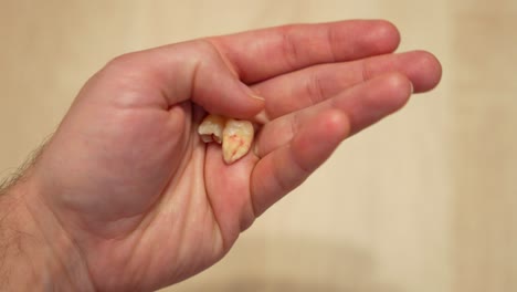 Dentist-holds-two-wisdom-teeth-with-big-curved-roots-in-hand,-showing-to-camera