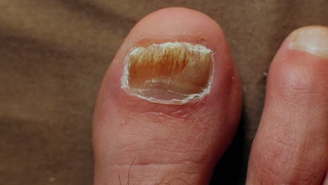 Applying-potent-anti-fungal-medication-to-big-toe-nail