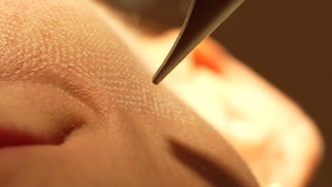 Close-up-of-skin-being-treated-with-a-precision-tool,-showcasing-the-detail-of-the-pores-and-the-fine-skill-involved-in-dermatological-procedures