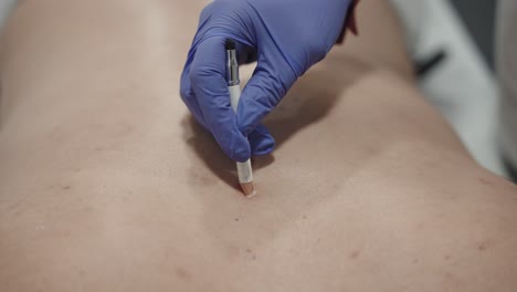 Marking-skin-with-white-pencil-for-laser-safety-before-hair-removal