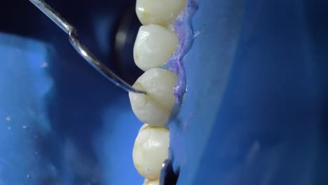 Close-up-view-of-a-dental-cleaning