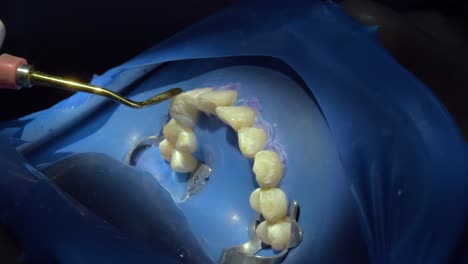 La-Precisión-De-La-Limpieza-De-Los-Dientes-Durante-La-Cirugía-Mientras-Un-Dentista-Utiliza-Herramientas-De-Manera-Experta