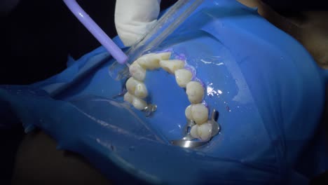 -Procedimiento-Dental-De-Limpieza-De-Dientes-Durante-La-Cirugía,-Ya-Que-El-Dentista-Inserta-Agua-De-Forma-Experta.