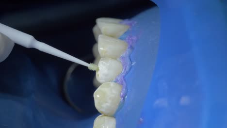 Erleben-Sie-Den-Detaillierten-Prozess-Der-Zahnreinigung-Aus-Nächster-Nähe,-Während-Ein-Zahnarzt-Geschickt-Werkzeuge-Einsetzt