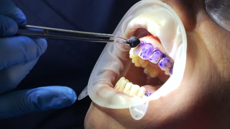 Zahnarzt-Verteilt-Sanft-Violettes-Mittel-Zur-Plaque-Entfernung-Auf-Den-Zähnen-Einer-Patientin-Aus-Nächster-Nähe