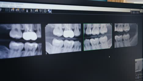 Radiografías-Dentales-De-Dientes-En-Una-Pantalla-De-Computadora-En-Un-Consultorio-Dental