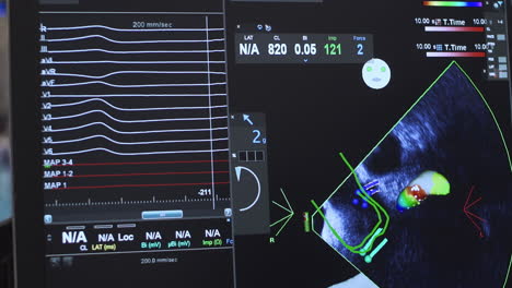 Echokardiogramm-Eines-Patienten-Auf-Dem-Monitor-In-Der-Kardiologieabteilung,-Herzgesundheit,-4k