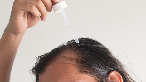 man-applying-minoxidil-to-hair-with-dropper,-baldness