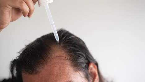 man-applying-minoxidil-to-hair-with-dropper,-baldness,-Alopecia