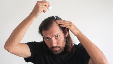 man-applying-minoxidil-to-hair-with-dropper,-baldness,-Hair-restoration